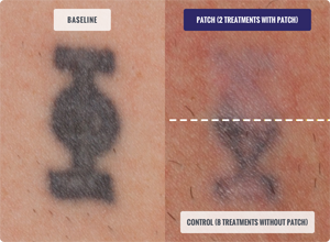 DESCRIBE Patch Before and After Tattoo Removal Results Photo after 8 Treatments with Patch