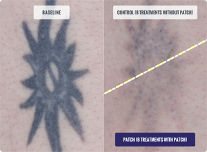 DESCRIBE Patch Before and After Tattoo Removal Results Photo after 8 Treatments with Patch