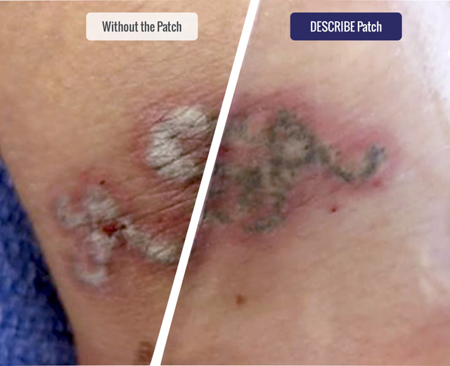 What Are the Fundamentals of Laser Tattoo Removal Training?