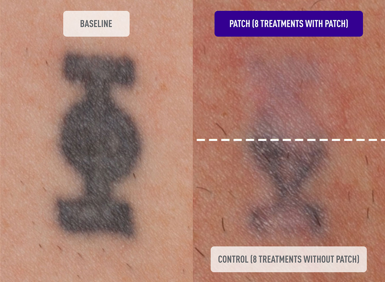 How Do You Care for a Tattoo Before & After a Laser Tattoo Removal  Treatment? - Original You