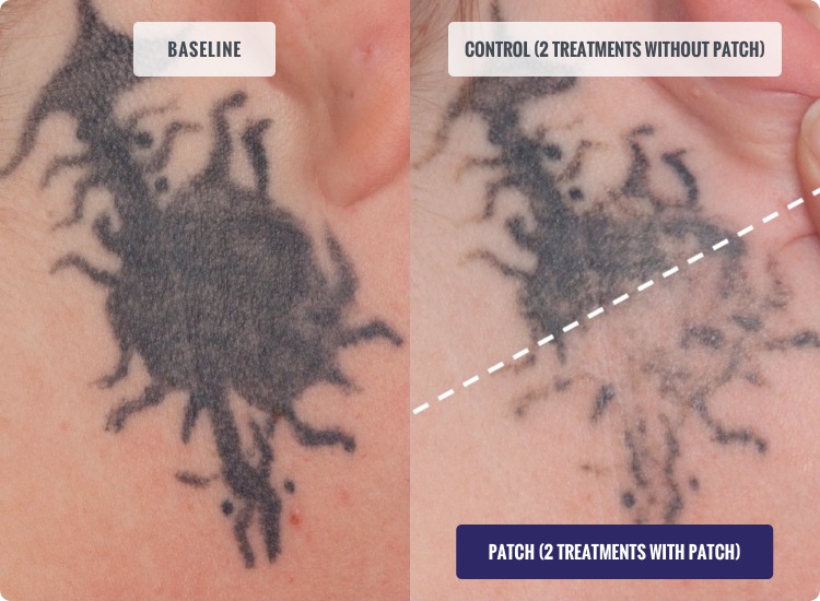 DESCRIBE Patch Before and After Tattoo Removal Results Photo after 2 Treatments with Patch