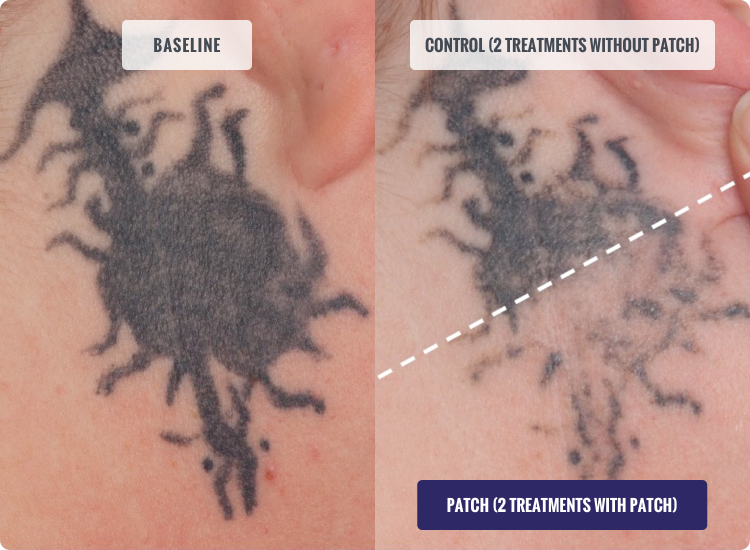 Tattoo Removal - The SHAPINS Clinic