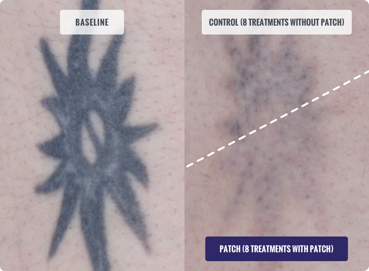 DESCRIBE Patch Before and After Tattoo Removal Results Photo after 8 Treatments with Patch